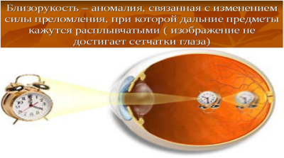 Расплывчатое изображение близко расположенных предметов является признаком