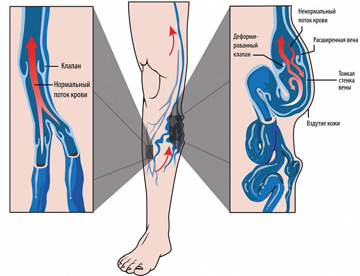 варикоз, варикозное расширение вен